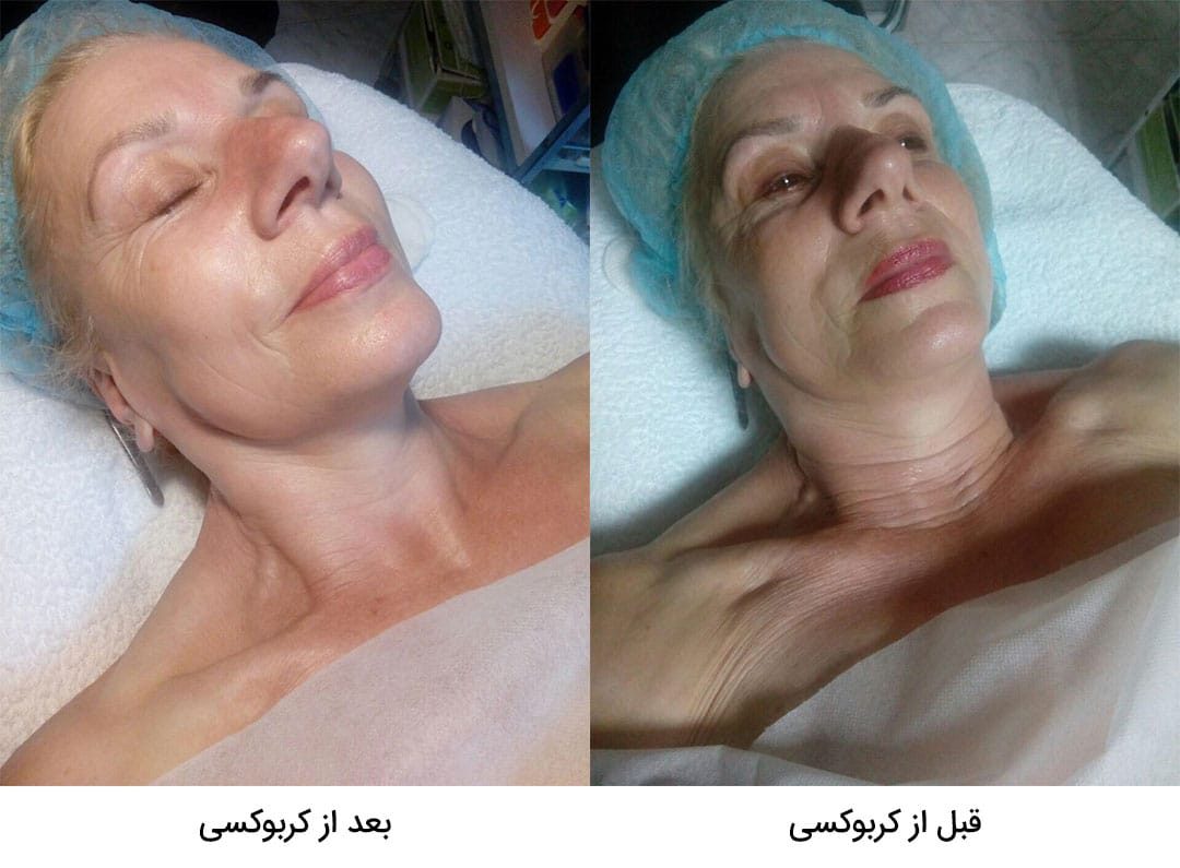 قبل و بعد از کربوکسی