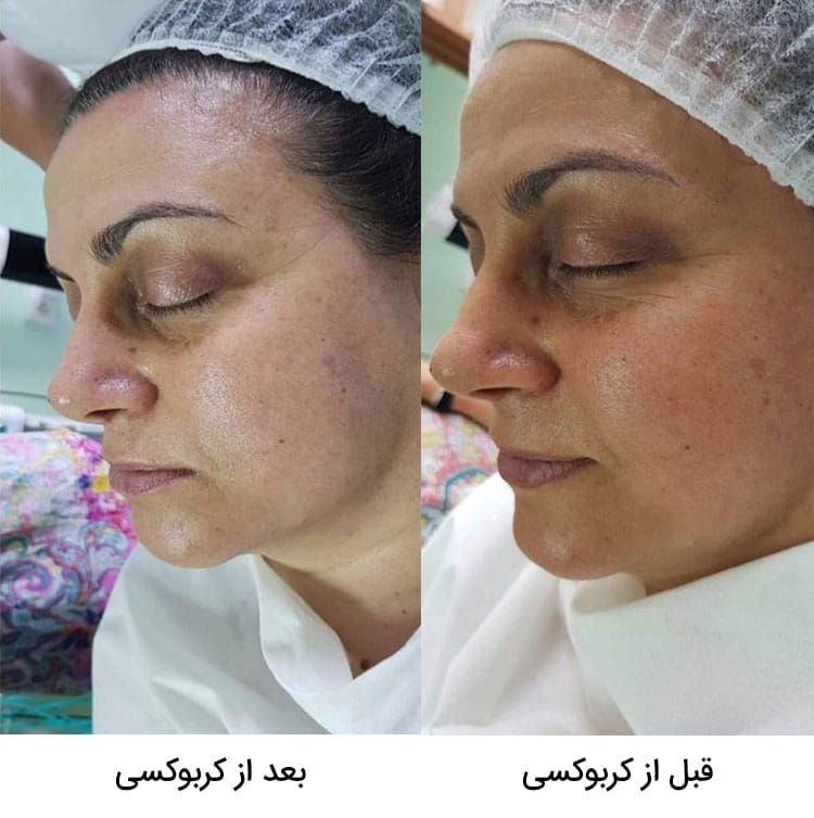 قبل و بعد از کربوکسی