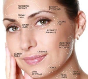 نواحی تزریق ژل هیالورونیک اسید در صورت