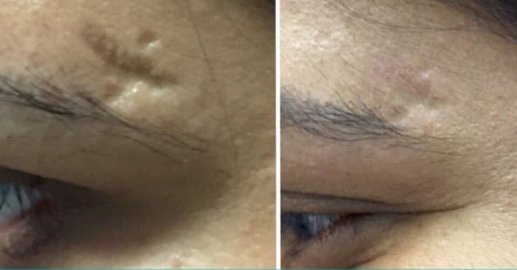 از بین بردن جای زخم ، بخیه و ترک های چاقی توسط دستگاه پلاسما جت (دستگاه پلکسر)