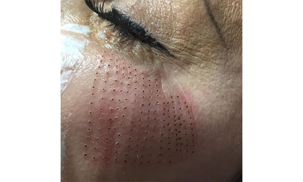 میکروبرن ایجاد شده توسط پلاسماجت