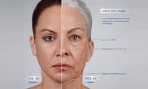 افتادگی پوست صورت و ایجاد چین و چروک در آن