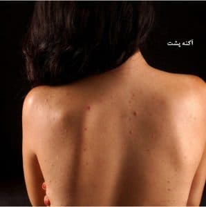آکنه وجوش کمر و پشت