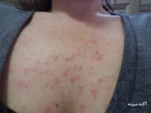 آکنه وجوش سینه