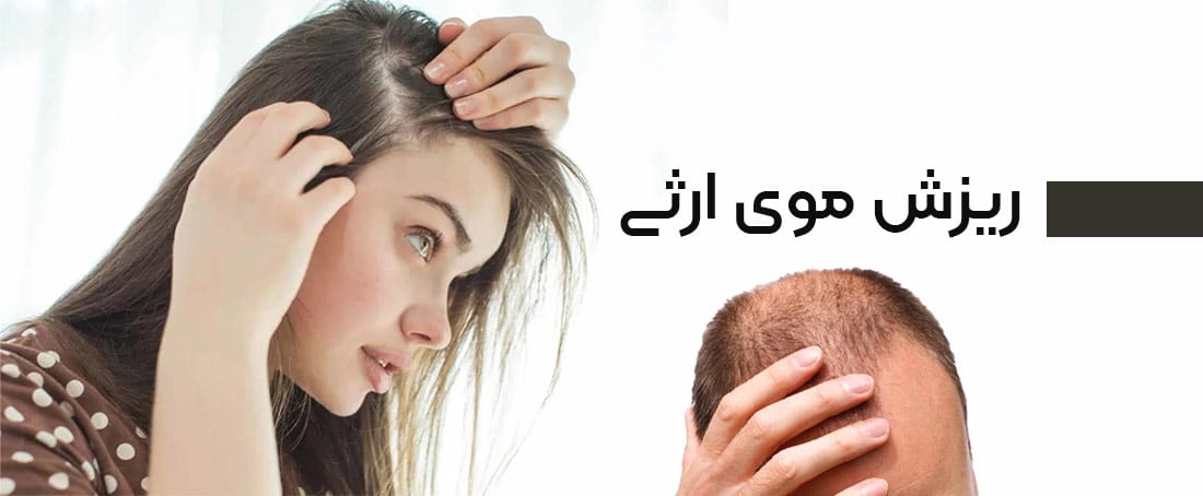 ریزش موی ارثی