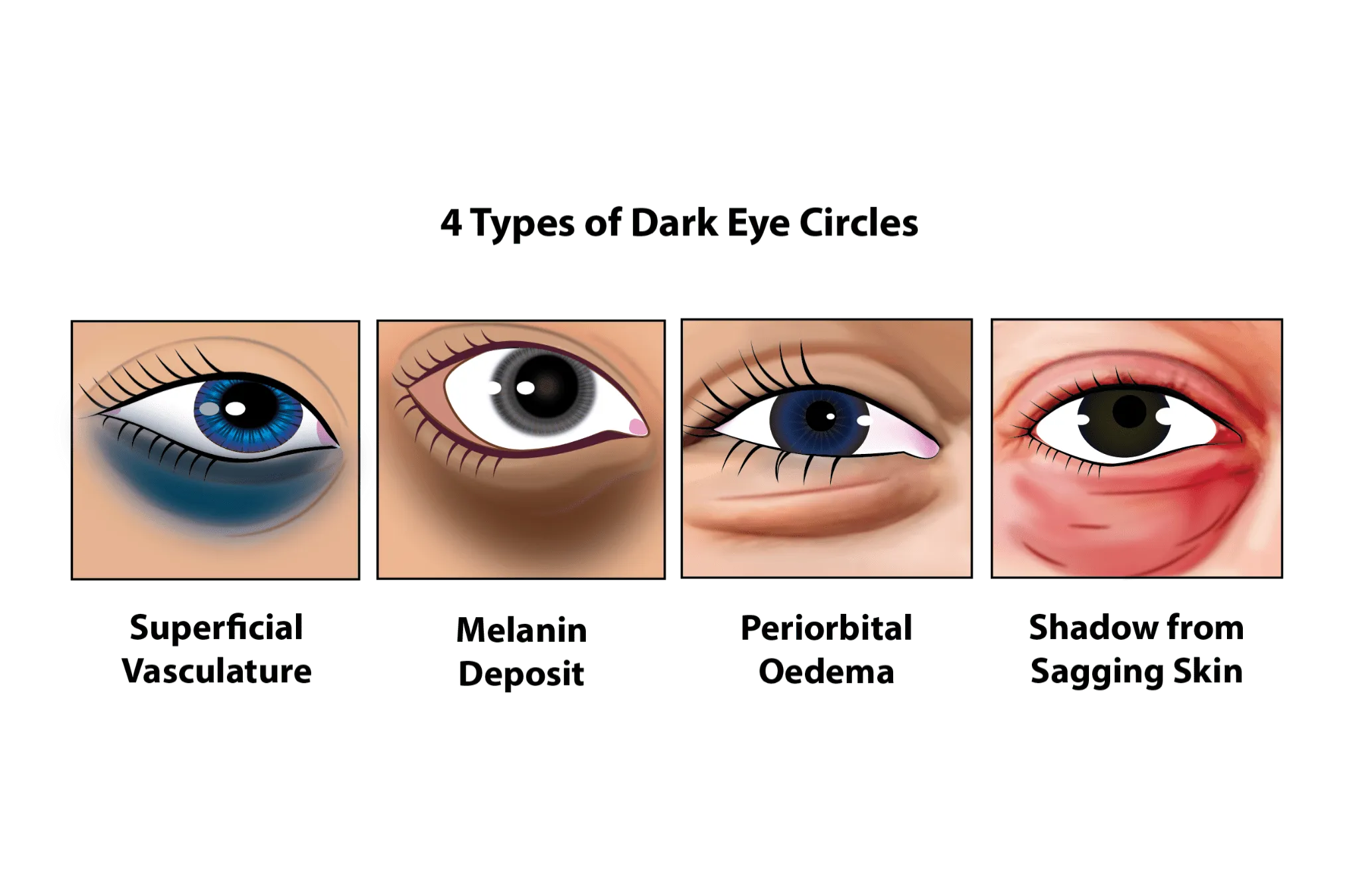 انواع تیرگی دور چشم