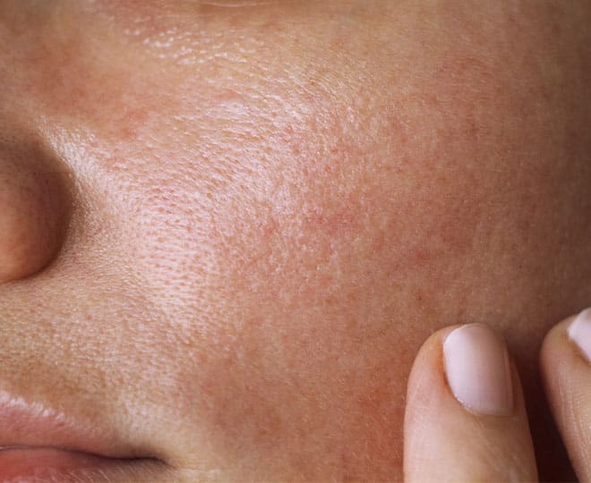 نمونهای از پوست چرب با منافذ باز (چربی بیش از حد در پوست)